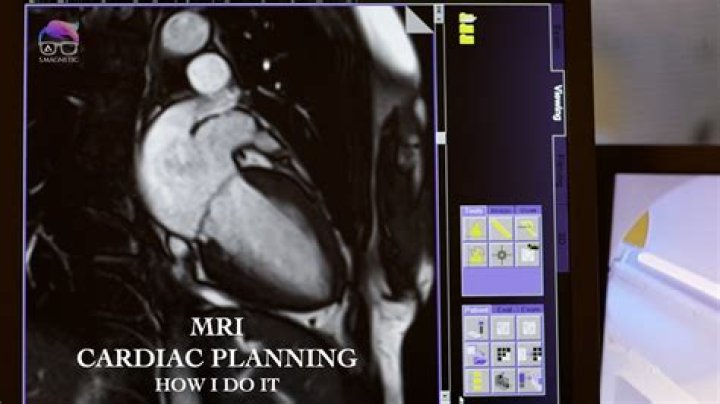 MRI Cardiac Planning PDF: Essential Guide for Accurate Heart Imaging