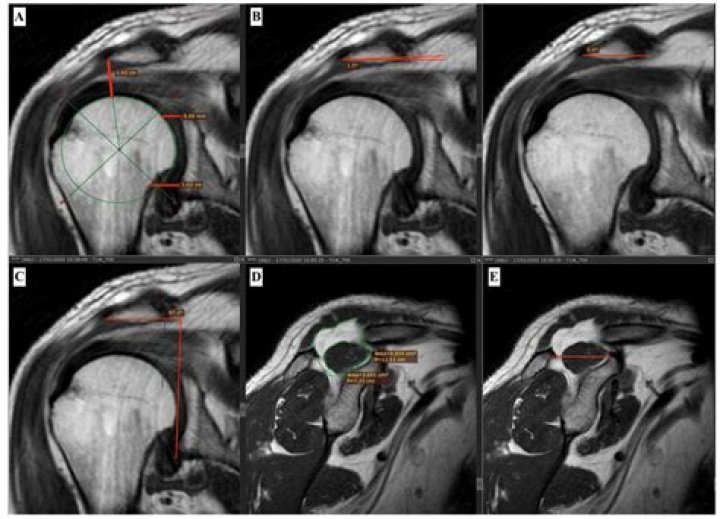 MRI Shoulder Planning PDF: Complete Guide for Diagnosis & Treatment