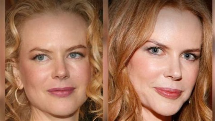 Nicole Kidman plastic surgery before and after Nicole Kidman, Facial