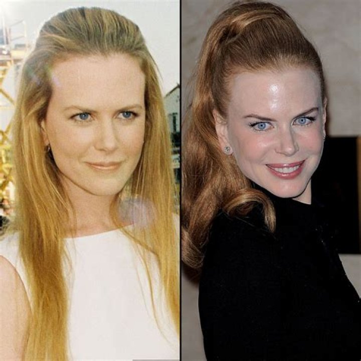 Nicole Kidman's Plastic Surgery Regret See Her Frozen Face Before and