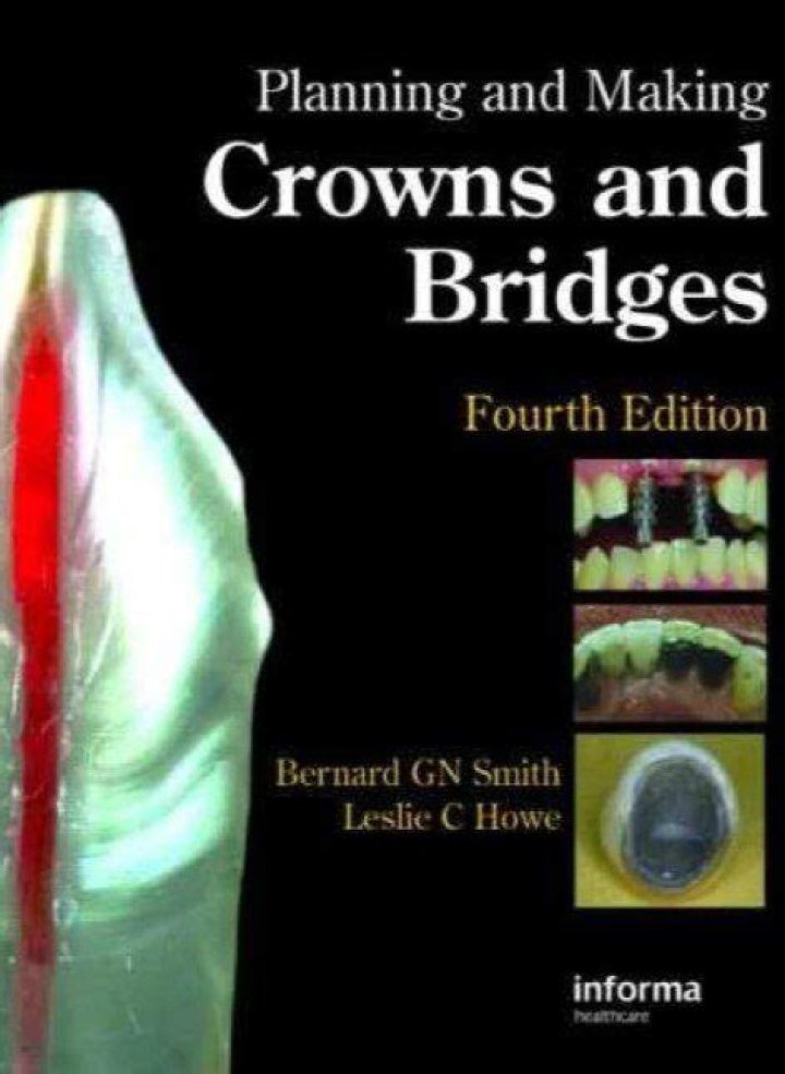 Step-by-Step Guide to Planning and Making Crowns and Bridges PDF