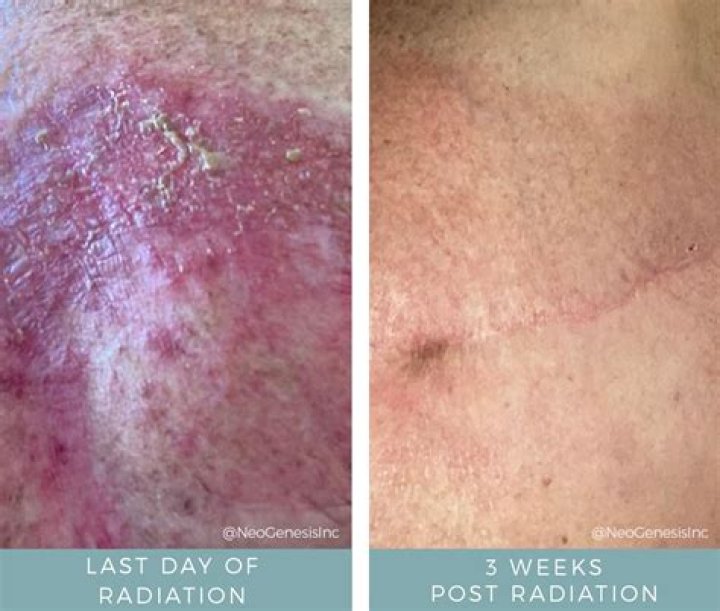 The Devastating Radiation Burns Of Hisashi Ouchi A Tragedy In Japan