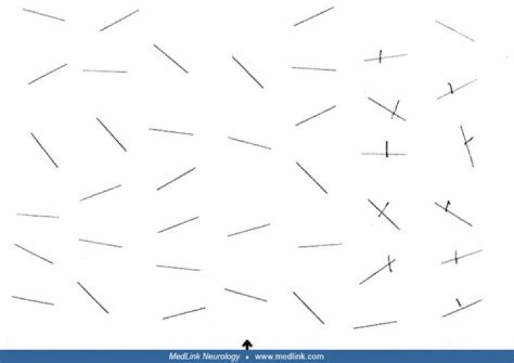 Visual Neglect Test PDF: Reliable Screening Tool for Cognitive Assessment