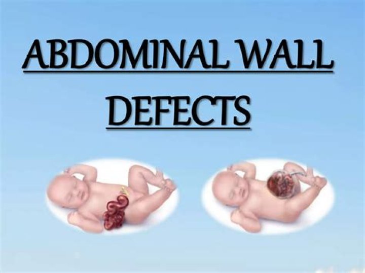 What are abdominal wall defects?