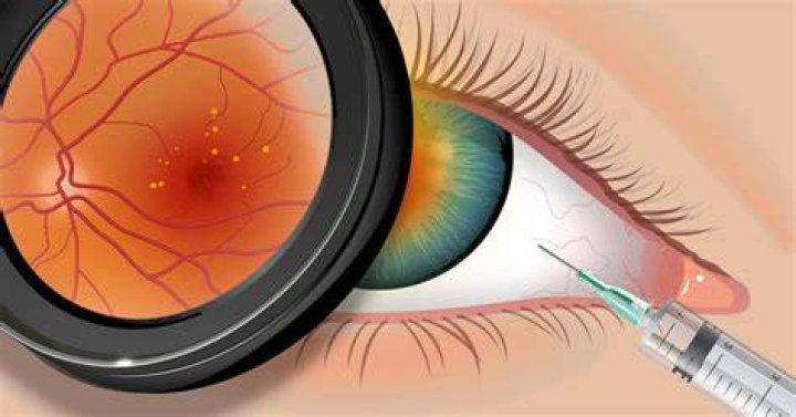 What are the side effects of Avastin eye injections?