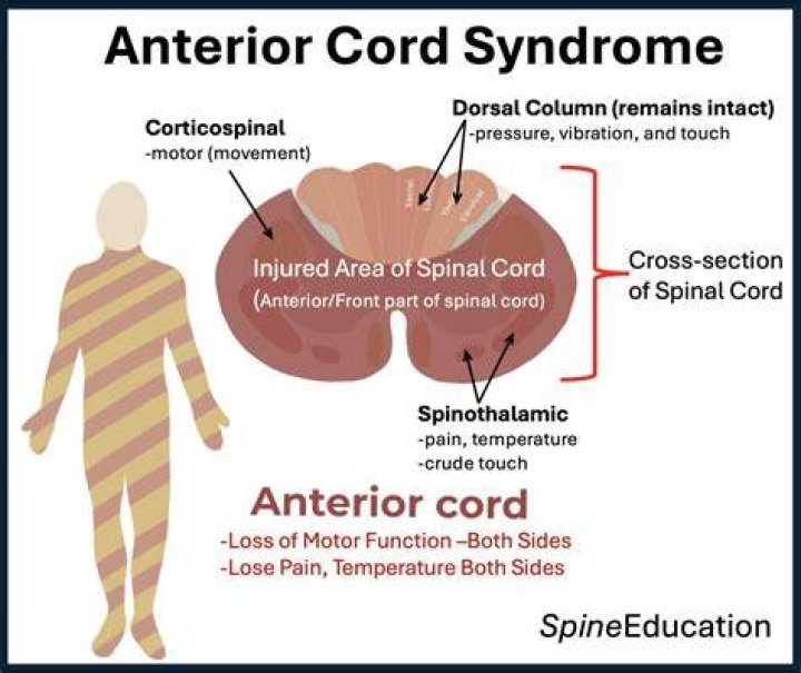 What are the symptoms of anterior cord syndrome?