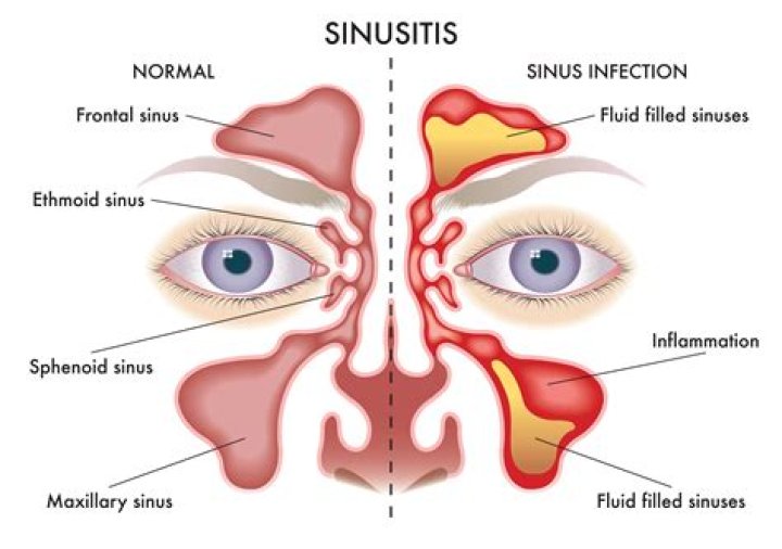 What are the symptoms of bad sinuses?