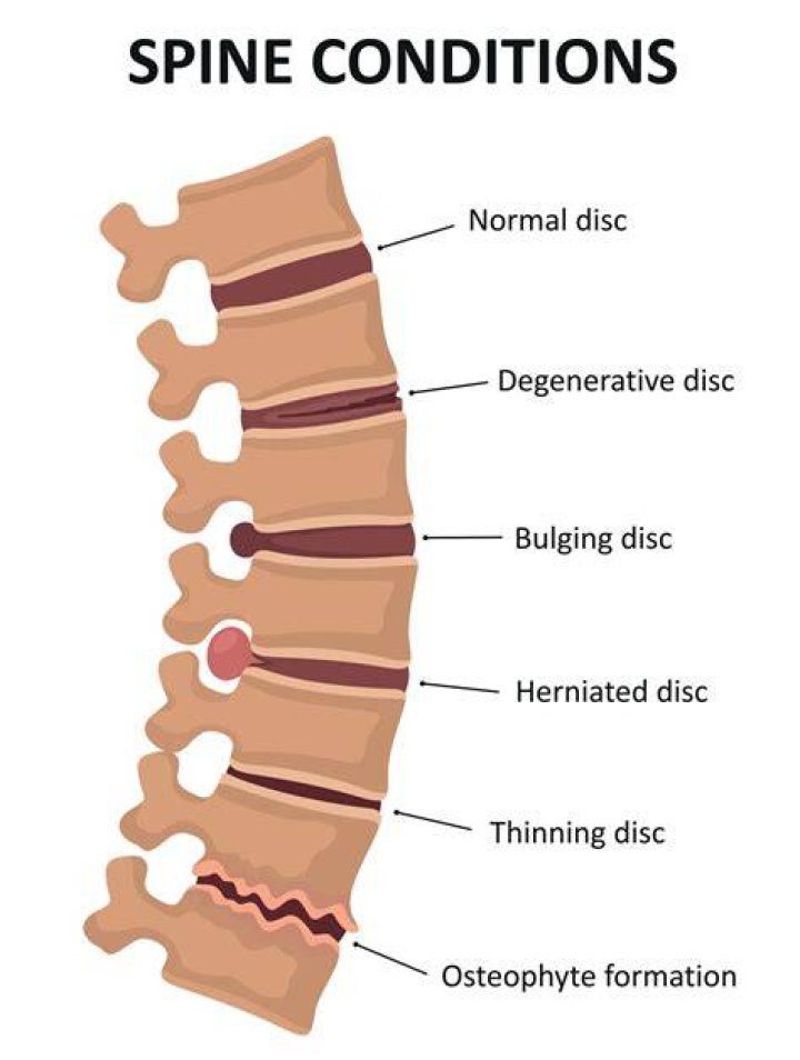 What causes lesions on the vertebrae?