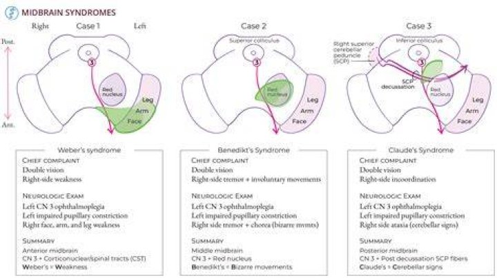 What causes midbrain lesion?