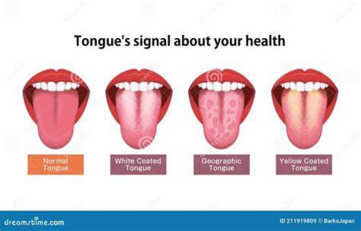 What causes white coated tongue and dry mouth?
