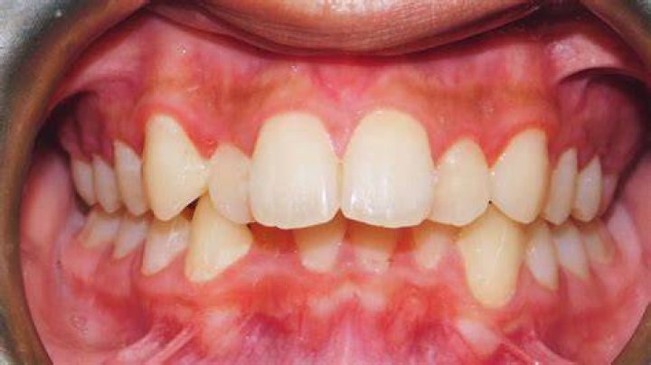What class is Proclined upper incisors?