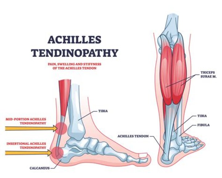 What does Achilles stand for?