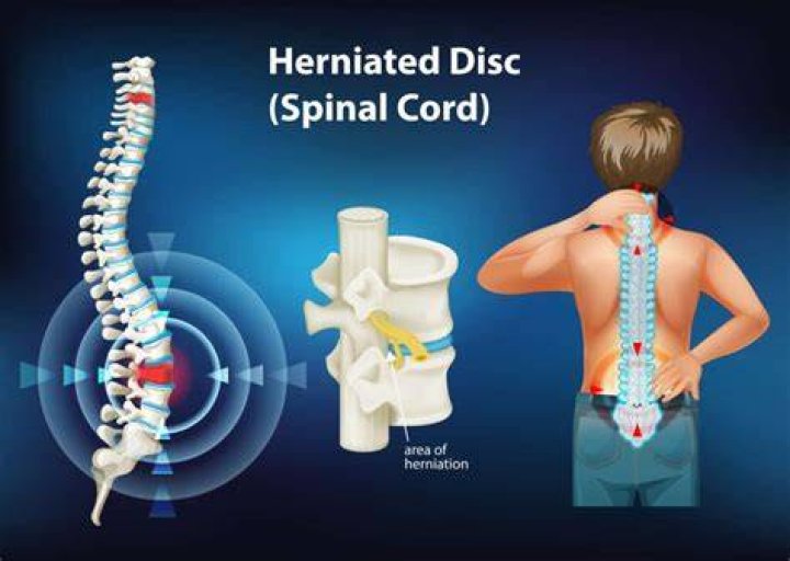 What does cervical herniation feel like?