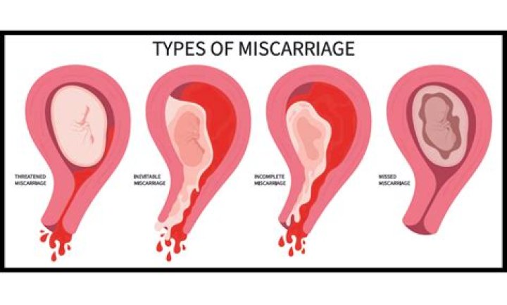 What does it look like when you have a miscarriage at 7 weeks?