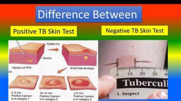 What does smear-negative TB mean?