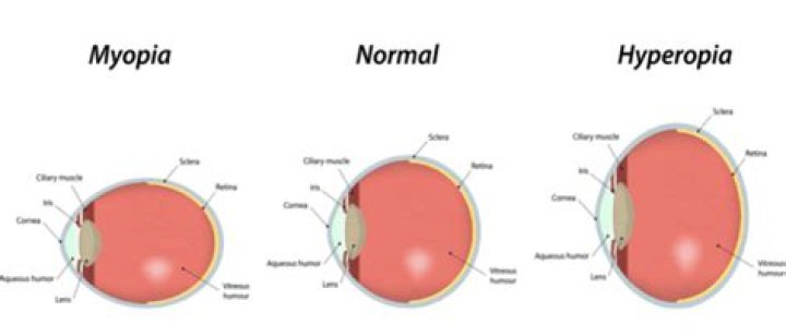 What happens to eyeball in myopia?