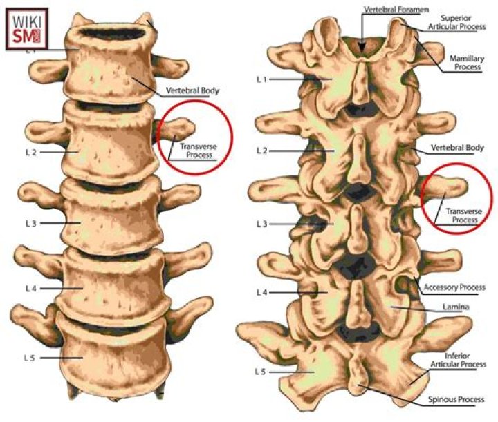 What is a vertebral process fracture?