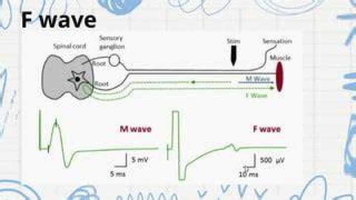 What is an F-wave study?