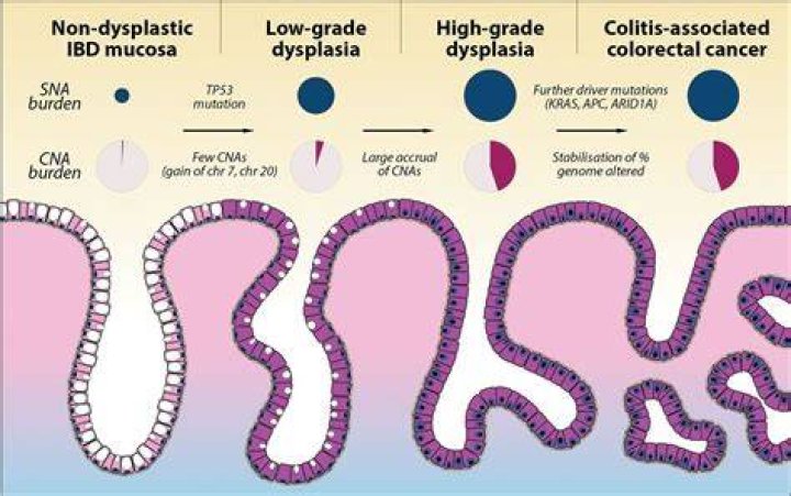 What is colitis associated colorectal cancer?