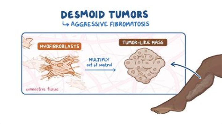 What is desmoid tumor?