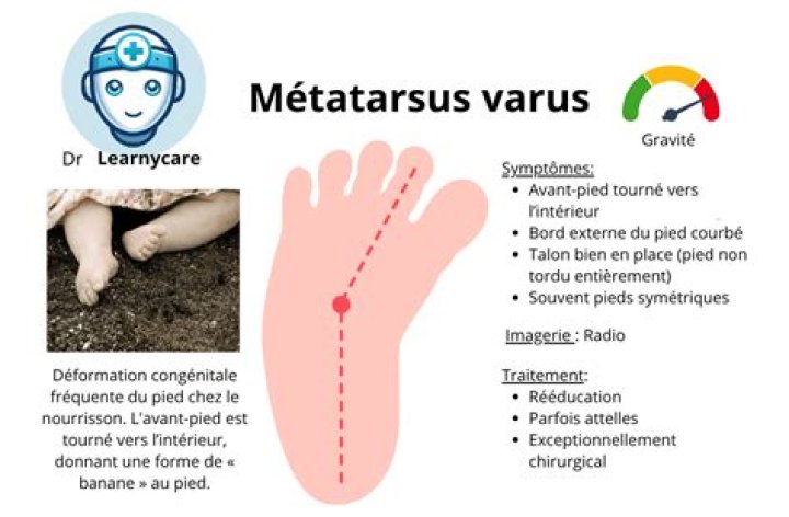 What is metatarsus varus?