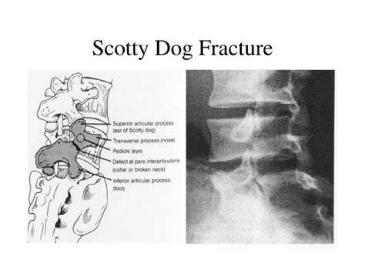 What is Scotty dog fracture?