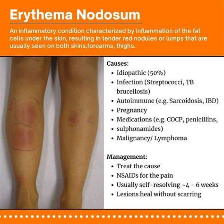What is the best treatment for erythema nodosum?