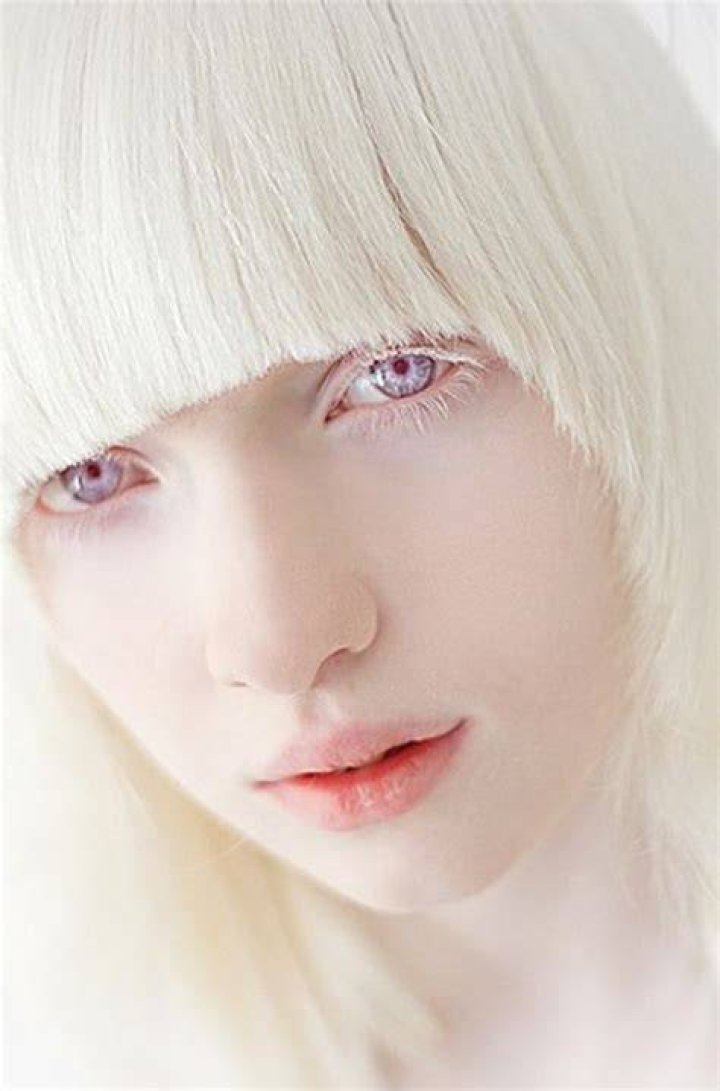 What is the hair color of albinos?