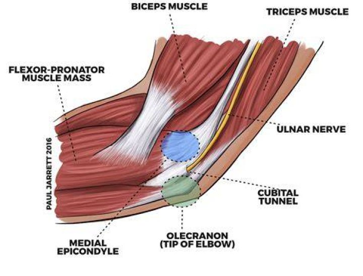 What muscles are affected by cubital tunnel syndrome?