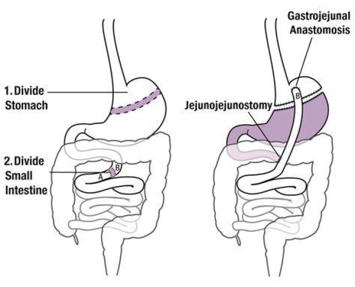 Where is the Gastrojejunal anastomosis located?