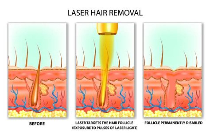 Which laser hair removal is permanent?