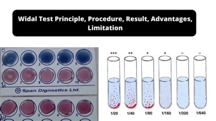 Widal Test Slide Method PDF: Step-by-Step Guide