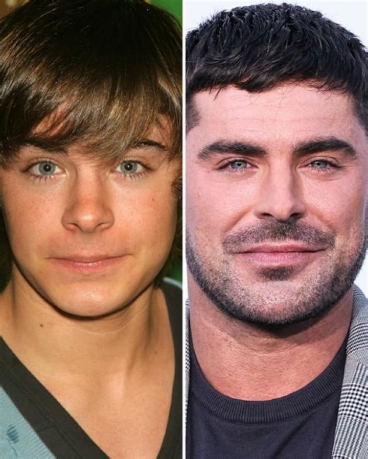 Zac Efron Before and After Has He Had Any Plastic Surgery? Zac efron