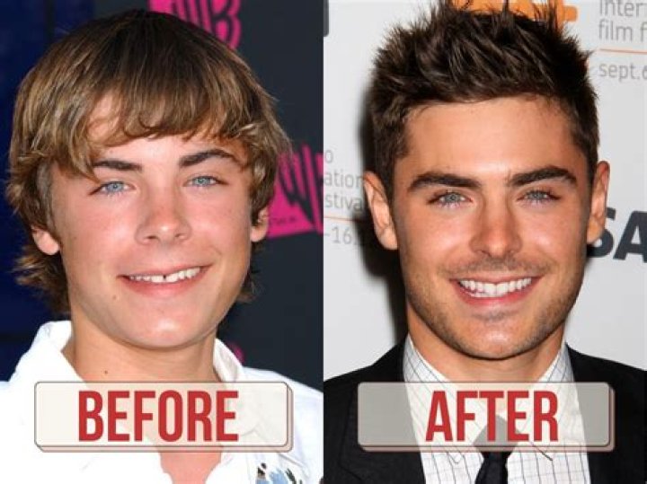 Zac Efron Face Before & After Jaw Surgery, Plastic Surgery, Filler